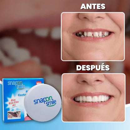 Carillas Dentales HappySmile®