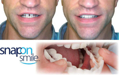 Carillas Dentales HappySmile®